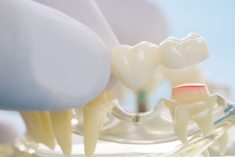 Dental Implants​