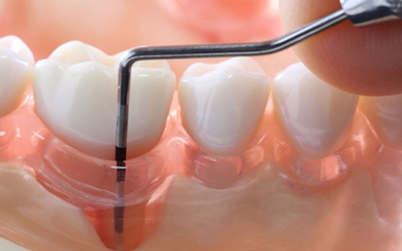Estrella Periodontal Disease