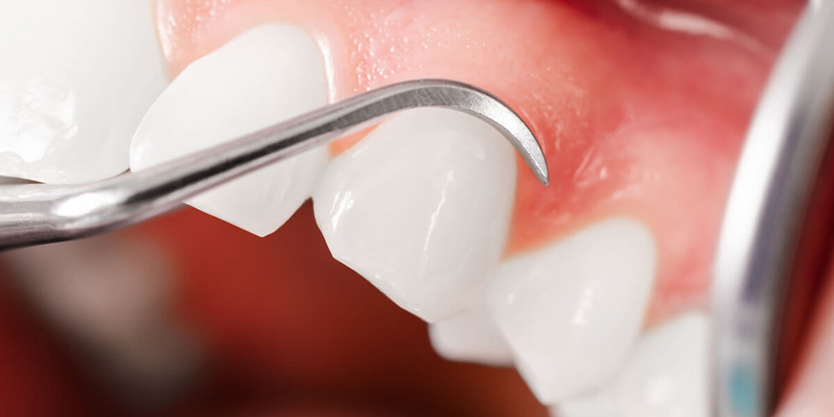 Estrella Periodontal Disease