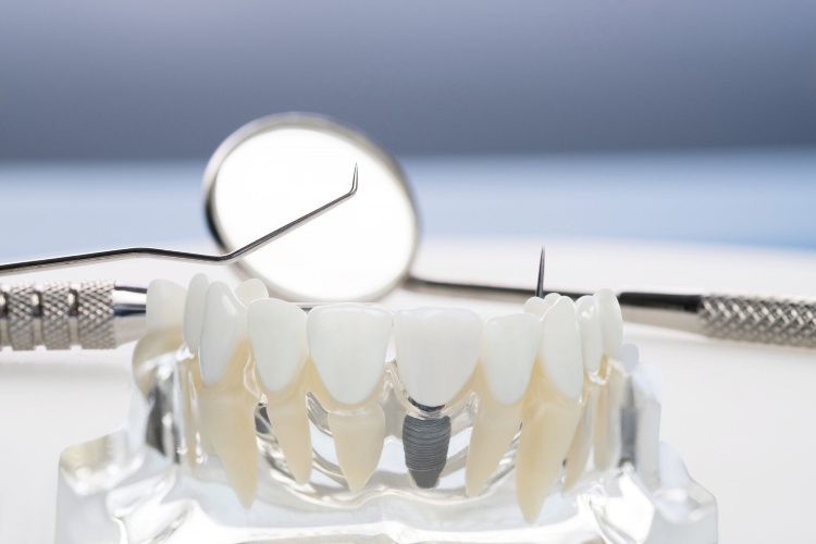 Estrella dental implants img 1