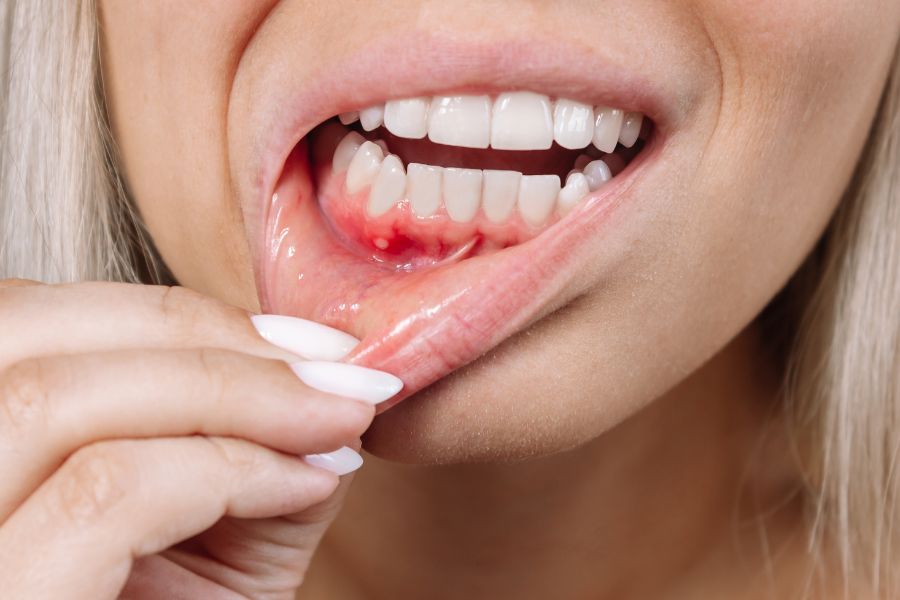 Estrella Periodontal Disease
